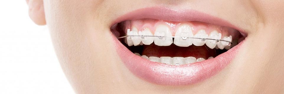 Types Of Braces Manhattan Beach, CA | Orthodontics Clear Braces